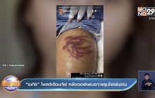 “เมทัล” โพสต์​เตือนภัย! หลังเจอพิษแมงกะพรุน​ไฟเล่นงาน