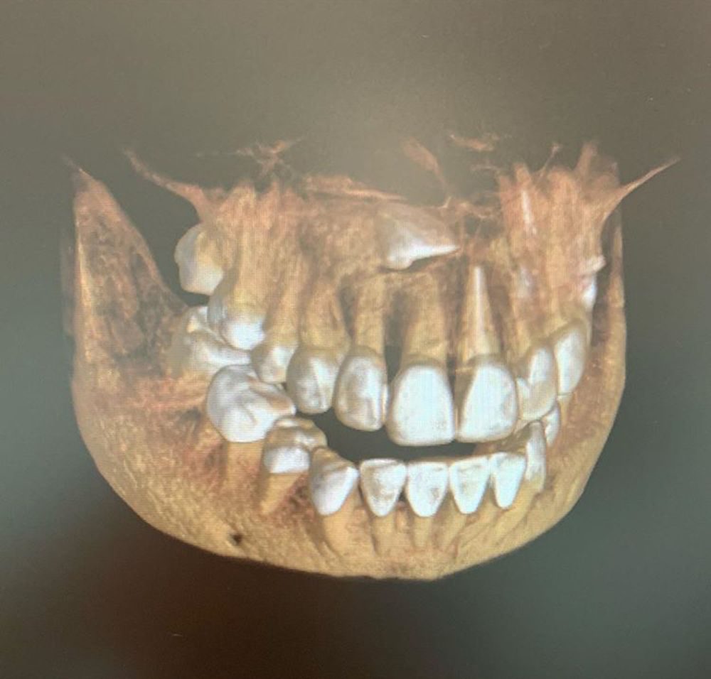 ภาพเอ็กซเรย์ฟันของ บูม สุภาพร ฟันคุดขึ้นตรงกลางใกล้เส้นประสาท