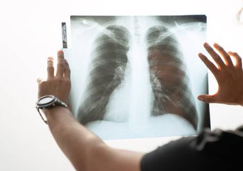 ไทยเผชิญวิกฤตมะเร็งปอดพุ่ง! พบผู้ป่วยใหม่วันละ 48 ราย เสียชีวิตวันละ 40 ราย ชี้มลพิษอากาศ-PM2.5 ตัวการสำคัญ