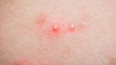 5 ข้อควรรู้เกี่ยวกับ สิวที่ก้น พร้อมกู้คืนก้นเนียนสวยไร้สิว