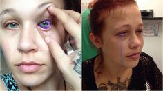 สาวพลาด สักตา ติดเชื้อรุนแรง น้ำตาเป็นสีม่วง เสี่ยงมองไม่ชัดตลอดชีวิต!!!