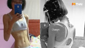 ป่วยโรคคลั่งผอม หนักแค่ 37 กก. หุ่นเหลือแต่กระดูก จนต้องลุกขึ้นมาสู้