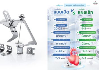 ทำความรู้จัก “เทคนิคผ่าตัดหัวใจแผลเล็ก” ทางเลือกใหม่เพื่อคุณภาพชีวิตคนไข้ที่ดีกว่า