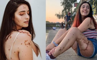 หญิงสาวผู้โตมากับคำบูลลี่ สู่การพบวิธีหาความสุขกับร่างกายตัวเอง ที่มีไฝบนตัวกว่า500เม็ด