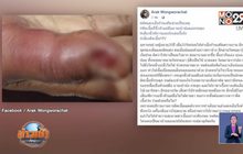 เตือนสาวต่อเล็บ ติดเชื้อลามถึงกระดูก