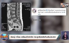 “พิชญ์ กาไชย” เตรียมตัวผ่าตัด กระดูกสันหลังทับเส้นประสาท