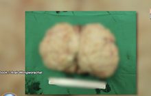 แพทย์ รพ.สิชล พบเนื้องอกมดลูกขนาดใหญ่ 20 เซนติเมตร