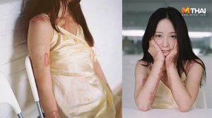 กว่าจะเข้มแข็ง! สาวน้อยยิ้มสู้กล้อง หลังจากถูกเพื่อนชายจุดไฟเผาจน เสียโฉม