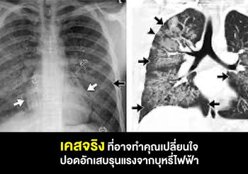 หากคุณคิดว่าสูบพอดไม่ร้าย ไม่อันตราย ลองฟังความจริงจากผู้ป่วยวัยรุ่นเหล่านี้คุณจะเปลี่ยนใจ