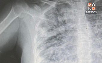 เด็กหญิงวัย 14 ป่วย EVALI หลังสูบบุหรี่ไฟฟ้า 1 ปี