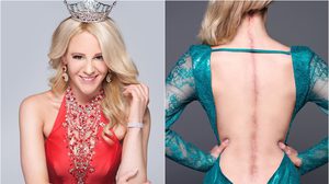 นางงามผู้มีแผลเป็นที่หลังยาว 25 นิ้ว รอยแผลเป็น คือพลังให้เธอชนะ