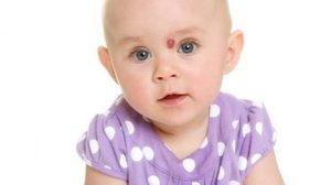 รู้จัก ปาน ของลูกแรกเกิด