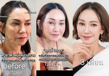 ปังมากแม่ “ดี้ ปัทมา” อัพเดทดึงหน้า ครบ 3 เดือน สวยจนคนทัก!