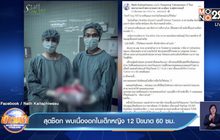 สุดช็อก พบเนื้องอกในเด็กหญิง 12 ปีขนาด 60 ซม.