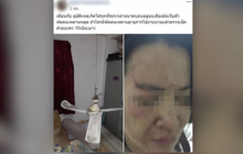 เตือนภัยพัดลมเพดานหลุดใส่หน้าขณะหลับ เย็บ 10 เข็ม