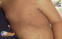 โรคหัดระบาดหนักในซามัว