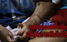 ครอบครัวร้องสื่อ แฉผัวโหด! ราดน้ำมันเผาอดีตเมียเสียโฉม หลังคดีไม่คืบหน้ากว่า 1 ปี ( คลิป )