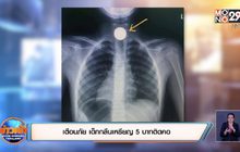 เตือนภัย เด็กกลืนเหรียญ 5 บาทติดคอ