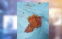 แพทย์โพสต์เตือนพบก้อนอาหารที่กลืนโดยไม่เคี้ยว-หวั่นอันตราย