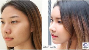 ผู้หญิงอย่าหยุดสวย!! ศัลยกรรมแปลงโฉม จากสาวหน้าบ้านๆ เปลี่ยนมาสวยได้ขนาดนี้?