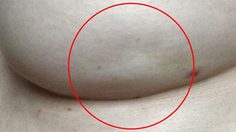 สัญญาณ มะเร็งเต้านม ที่คุณสามารถเช็คได้ด้วยตาของคุณเอง