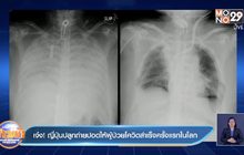 ญี่ปุ่น ประสบความสำเร็จ ปลูกถ่ายปอดให้ผู้ป่วยโควิด