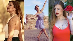 เกิดมามีสองแขนสองขา ก็โชคดีที่สุดแล้ว! สาวสเปนมีไฝทั่วตัว ทำตามฝันเป็นนักบัลเล่ต์