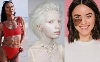 7 ผู้หญิงสตรองเผชิญกับโรคหายาก พลิกปมดอยเป็นความแกร่ง ส่งต่อแรงบันดาลใจ