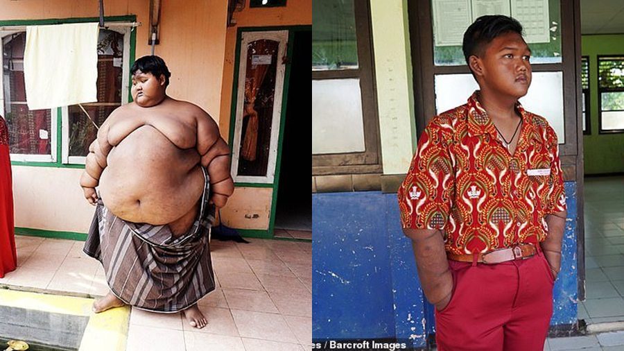 Arya Permana เด็กที่อ้วนที่สุดในโลก ตอนนี้เปลี่ยนแปลงตัวเอง กลับมาผอมแล้ว