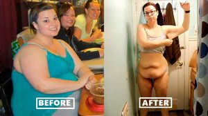 สาวพลาดอย่างแรง! ผ่าตัดกระเพาะอาหาร หวังลดน้ำหนัก แต่กลับได้พุงย้วยๆ มาแทน