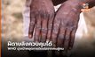 WHO ยืนยันฝีดาษลิงควบคุมได้ แพร่ระบาดได้ยาก พุ่งเป้าหยุดการติดต่อจากคนสู่คน