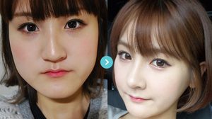 ศัลยกรรมเปลี่ยนชีวิต!! หญิงสาวที่ถูกล้อว่า กรามใหญ่ วันนี้เธอเปลี่ยนไปเป็นคนใหม่