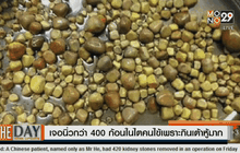 เจอนิ่วกว่า 400 ก้อนในไตคนไข้เพราะกินเต้าหู้มาก
