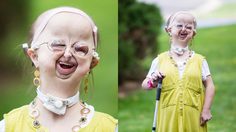 หญิงสาววัย 20 ป่วยเป็นโรคหายาก 1 ใน 5 ล้านคน แต่เธอยังยิ้มได้เสมอ และฝันอยากเป็นหมอ