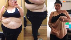 สาวอ้วน โพสต์ขอรับบริจาค เพื่อผ่าตัดกระชับหน้าท้อง หลังลดน้ำหนักไป 80 กิโล