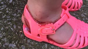 คุณแม่โวย หนูน้อยวัย 2 ขวบ เป็นแผลเหวอะ เลือดท่วม หลังถูก รองเท้ายาง บาด