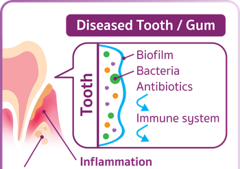 “ฟันผุ” ปัญหาระดับโลก รู้เท่าทัน ก่อนสูญเสียฟัน