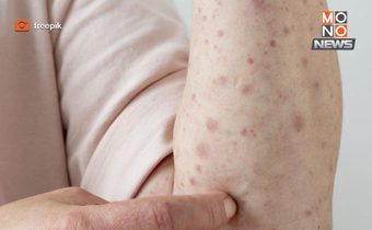 เอดส์ยังน่าห่วง! ไทยพบผู้ติดเชื้อใหม่เกือบ 9 พัน ตายทะลุหมื่นในปี 68