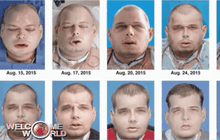 สหรัฐประสบความสำเร็จปลูกถ่ายใบหน้าครั้งใหญ่สุดในโลก