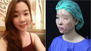 สาวเวียดนามถูกแฟนเก่า สาดน้ำกรด คืนชีวิตใหม่อีกครั้ง สานต่อความฝันเป็นพยาบาลฝึกหัด