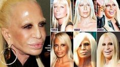 ดอนนาเทลล่า เวอร์ซาเช่ พัฒนาการหน้าเละ พิษศัลยกรรมตัวแม่