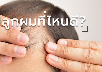 ปัญหาหนังศีรษะและเส้นผมกวนใจ อยากปลูกผม…แต่จะปลูกผมที่ไหนดีล่ะ