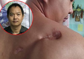 ดาบตำรวจโชว์บาดแผล ผลพวงโจรใต้ถล่ม ลั่นหากผมกลัว ชาวบ้านจะอยู่อย่างไร