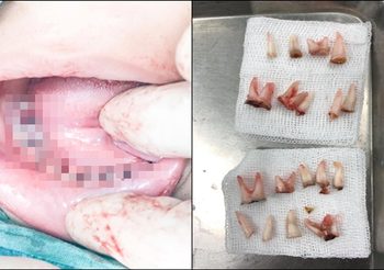 หมอเตือน! รักลูกต้องแปรงฟันให้ลูก หลังคนไข้เด็ก 4 ขวบ ถูกถอนฟัน 18 ซี่