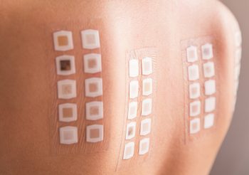 ทดสอบภูมิแพ้ผิวหนัง สำหรับผู้ที่ผิวแพ้ง่าย ด้วยวิธี Patch test