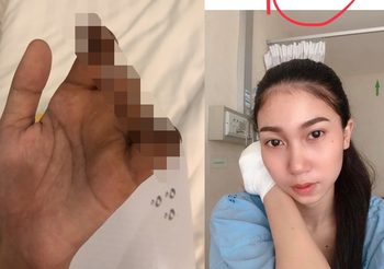 สาวโพสต์บทเรียนชีวิต หลังประสบอุบัติเหตุจนต้องสูญเสีย ระหว่างฝึกงาน