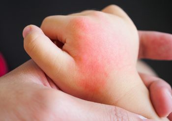 7 วิธีดูแลรักษาตัวเอง โรคภูมิแพ้ผิวหนัง ไม่ให้ผื่นกำเริบได้!!