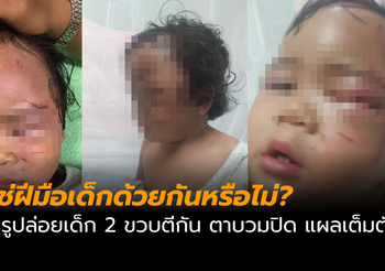 ครูปล่อยเด็ก 2 ขวบตีกัน แผลเต็มตัว ผู้ปกครอง สงสัยใช่ฝีมือเด็กด้วยกันจริงหรือ?