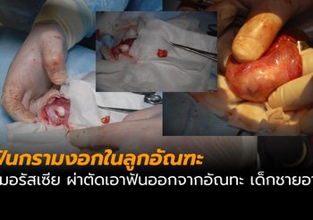 ตะลึง! แพทย์รัสเซียผ่าตัดฟันกรามงอกในอัณฑะ เด็กชายอายุ 13