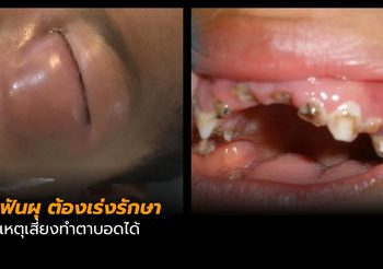 อีกแล้ว เด็ก 3 ขวบ ฟันผุรุนแรง หวิดทำตาบอด
